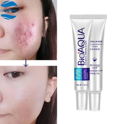 Premium Acne Removal Cream 30g All Skin Types